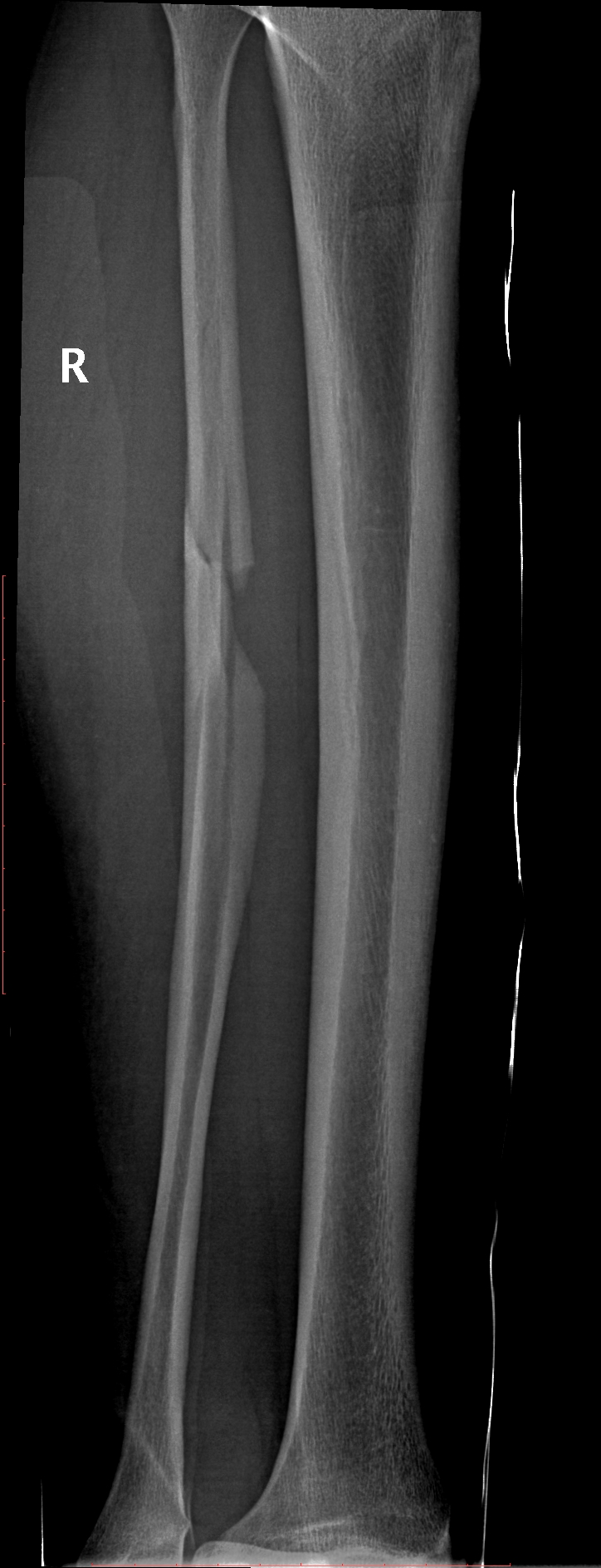 Maisonneuve fracture Image