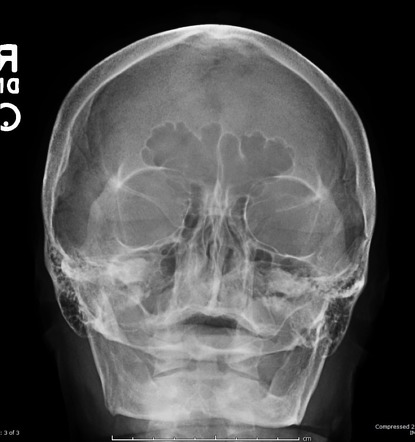 Edentulous jaw | Image | Radiopaedia.org