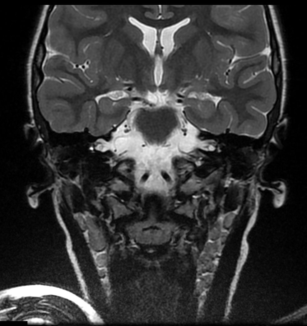 Labyrinthitis