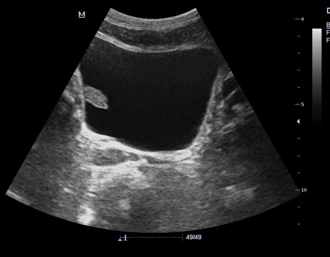 Камень в мочевом пузыре на узи фото