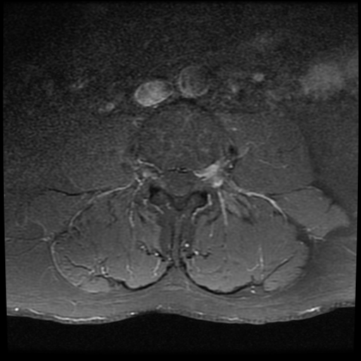 Foraminal/extraforaminal lumbar disc extrusion | Image | Radiopaedia.org