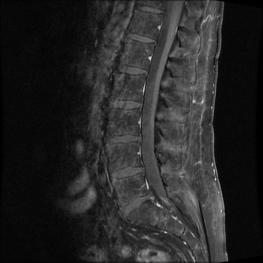 Foraminal/extraforaminal lumbar disc extrusion | Image | Radiopaedia.org