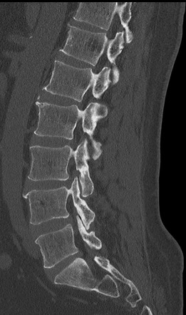 Foraminal/extraforaminal lumbar disc extrusion | Image | Radiopaedia.org