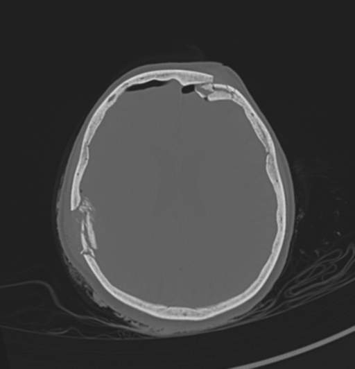 Depressed Skull Fractures (hammer) | Image | Radiopaedia.org