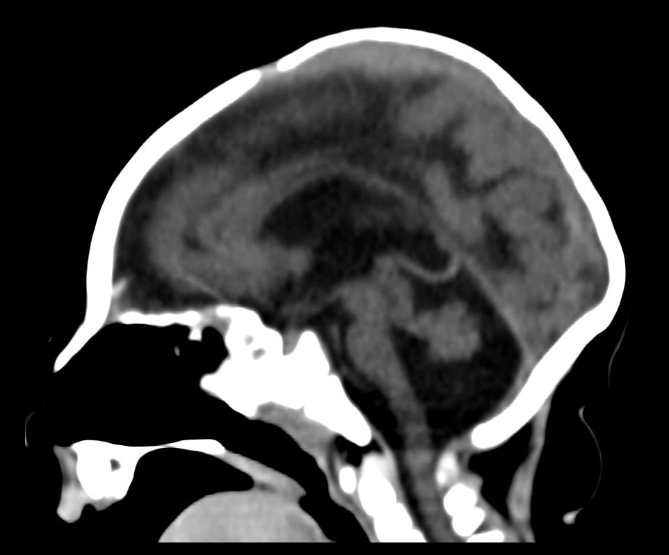 Lissencephaly with cerebellar hypoplasia | Image | Radiopaedia.org