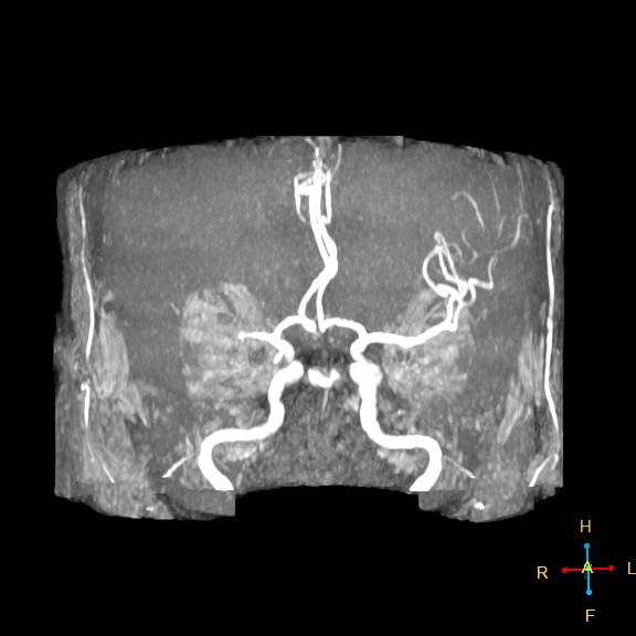 Mca Territory Infarction Image 0227