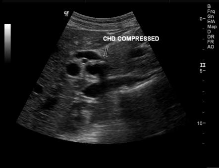 Mirizzi Syndrome Image Radiopaedia Org