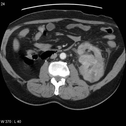 Renal Cell Carcinoma Radiology Case Radiopaedia Org