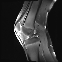 Flipped meniscus | Image | Radiopaedia.org