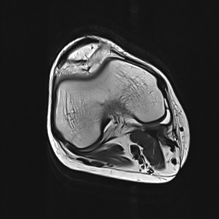 Flipped meniscus | Image | Radiopaedia.org