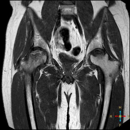 Avascular necrosis of the hip | Radiology Reference Article ...