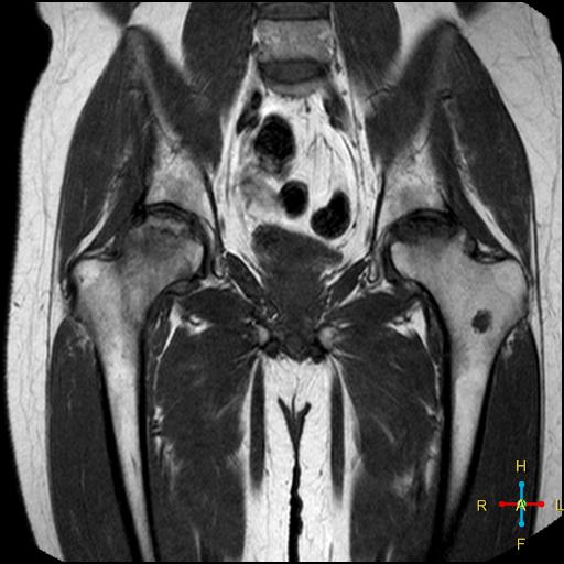 Avascular necrosis of femoral head | Image | Radiopaedia.org