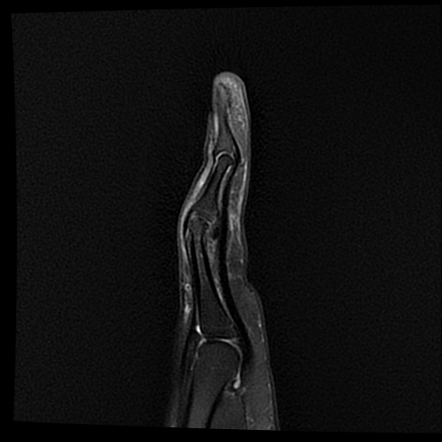 Proximal interphalangeal joint (PIP) dislocation with avulsion tear of ...