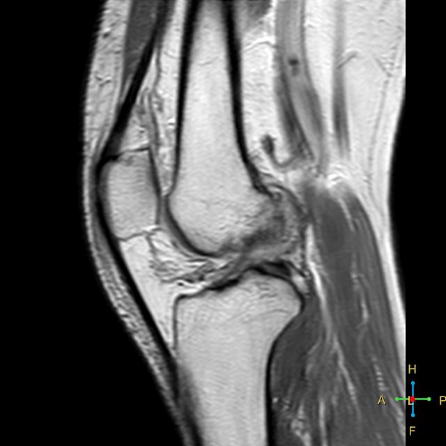 Spontaneous osteonecrosis of the knee (SONK) | Image | Radiopaedia.org