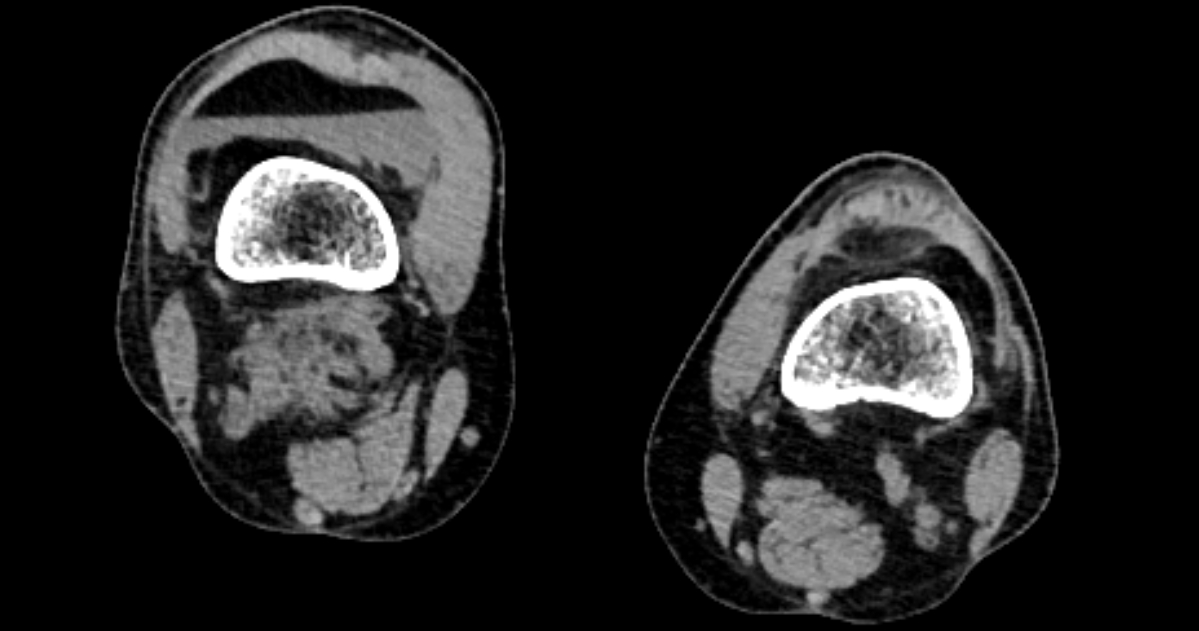 Lipohemarthrosis Image