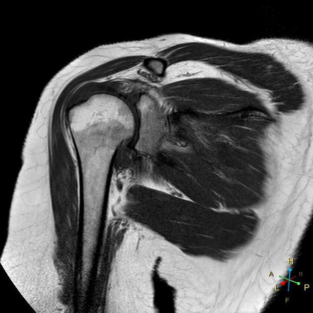 supraspinatus tendon tear