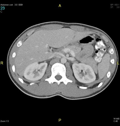 Nutcracker syndrome | Radiology Reference Article | Radiopaedia.org