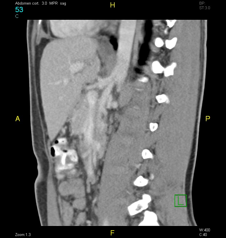 Nutcracker syndrome Image