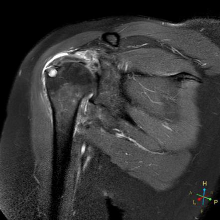 Алкоголизация Supraspinatus