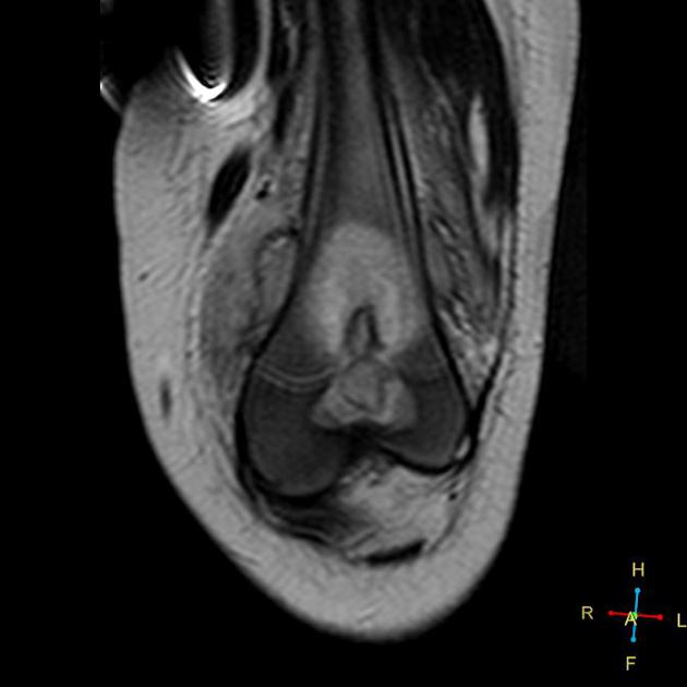 Brodie abscess Radiology Reference Article Radiopaedia