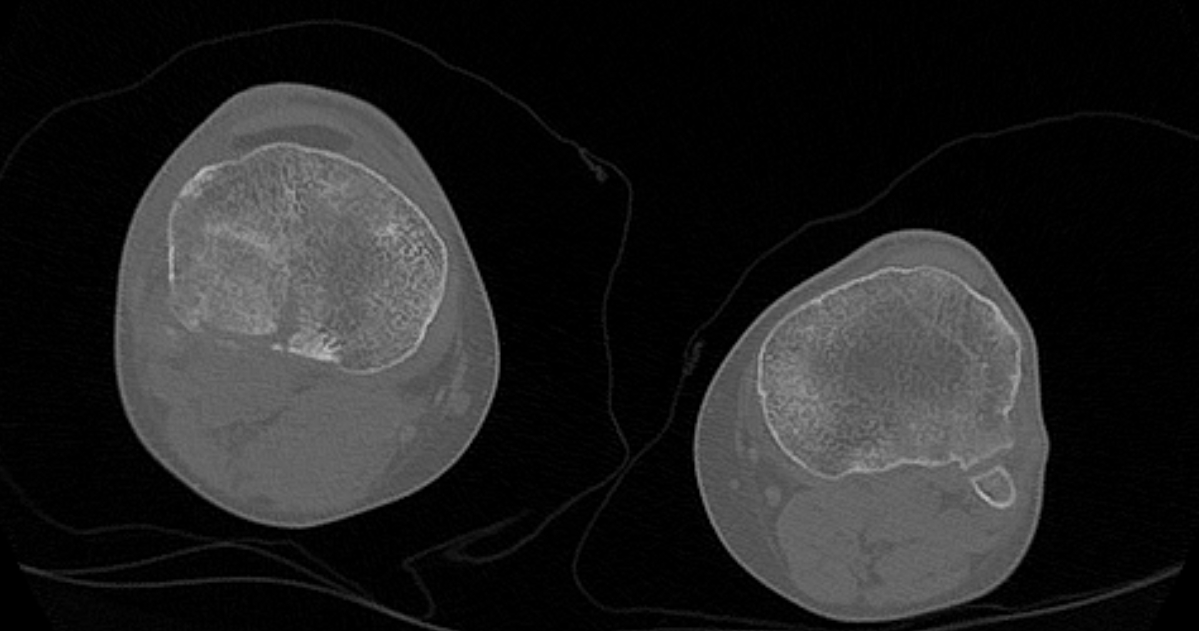 Lipohemarthrosis Image