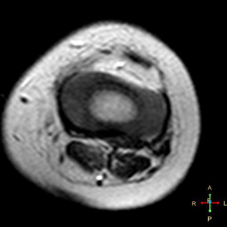 Brodie abscess | Image | Radiopaedia.org