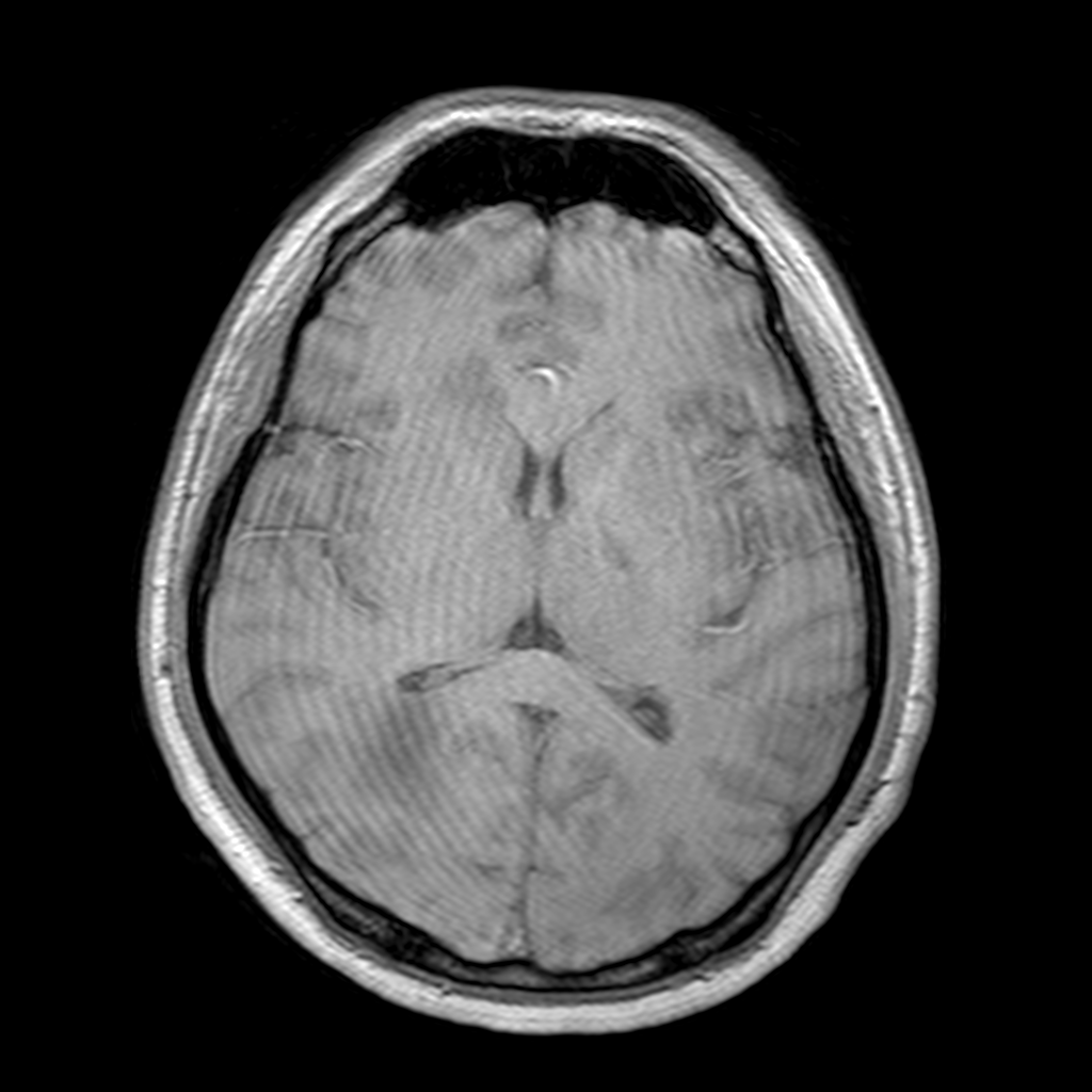 Acute disseminated encephalomyelitis (ADEM): Anti-NMDA receptor ...