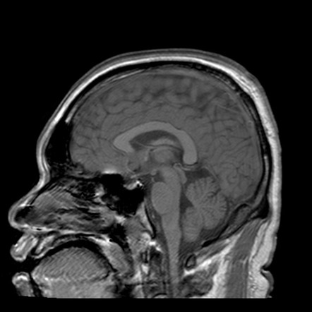 Acute disseminated encephalomyelitis (ADEM): Anti-NMDA receptor ...