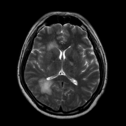 Acute disseminated encephalomyelitis (ADEM): Anti-NMDA receptor ...