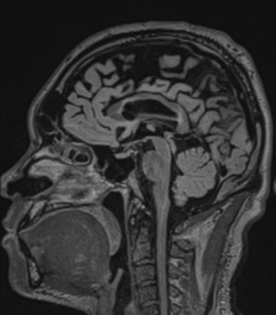 Acute disseminated encephalomyelitis (ADEM): Anti-NMDA receptor ...