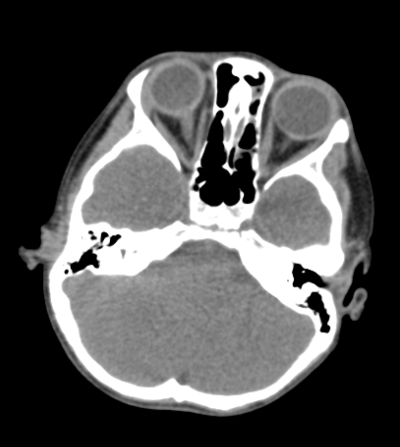 External auditory canal atresia | Image | Radiopaedia.org