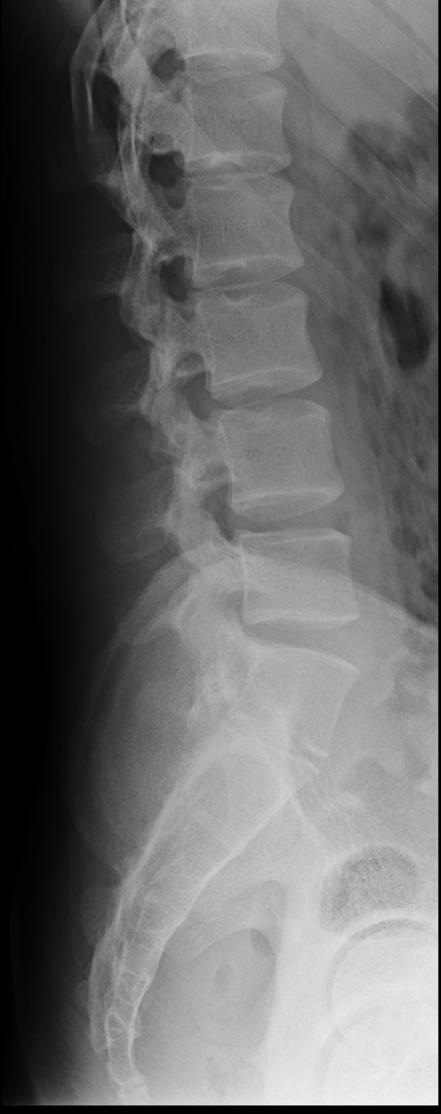 Non-united apophyses of the L1 transverse processes | Image ...