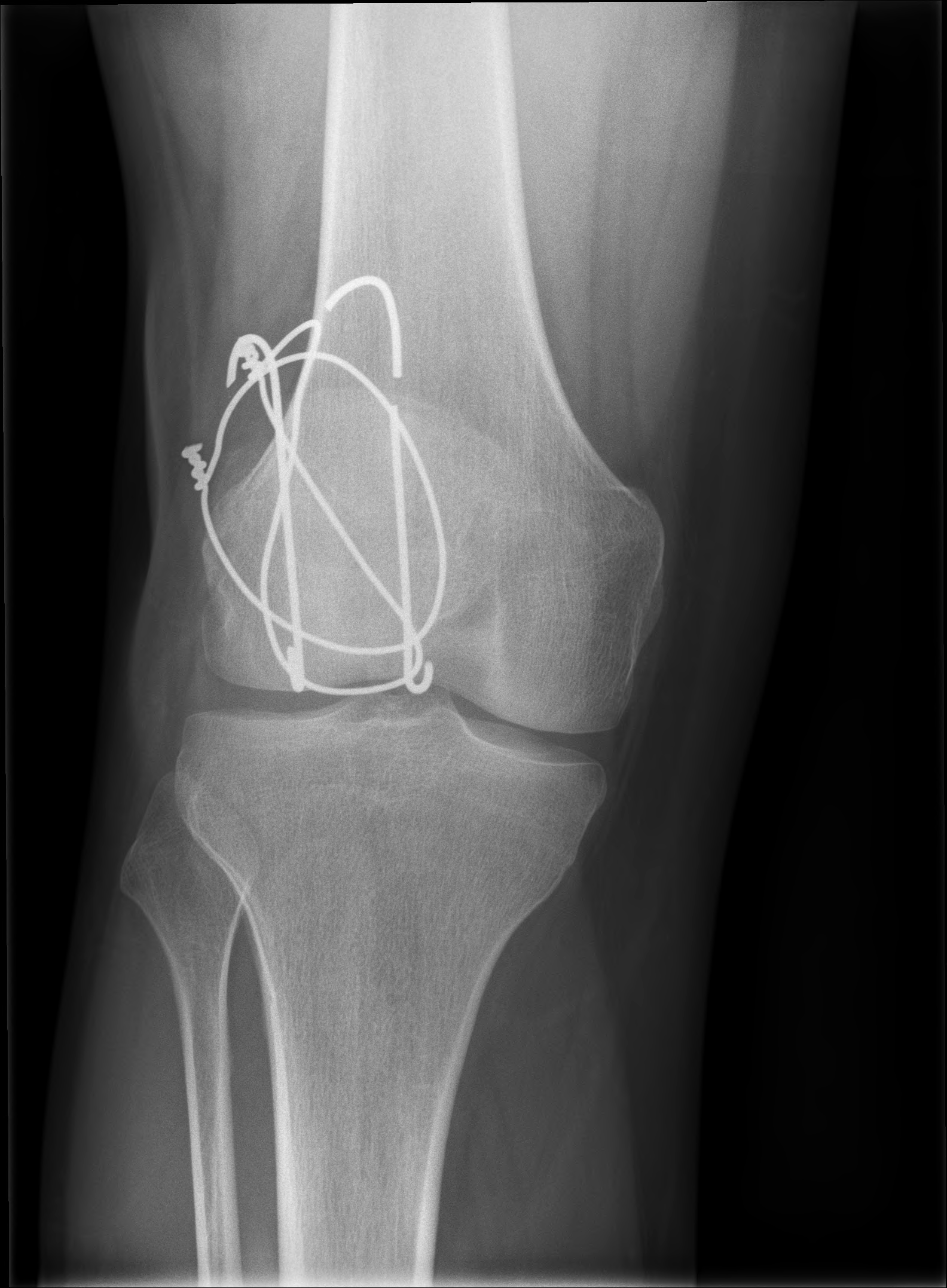 Broken Cerclage Wire | Image | Radiopaedia.org