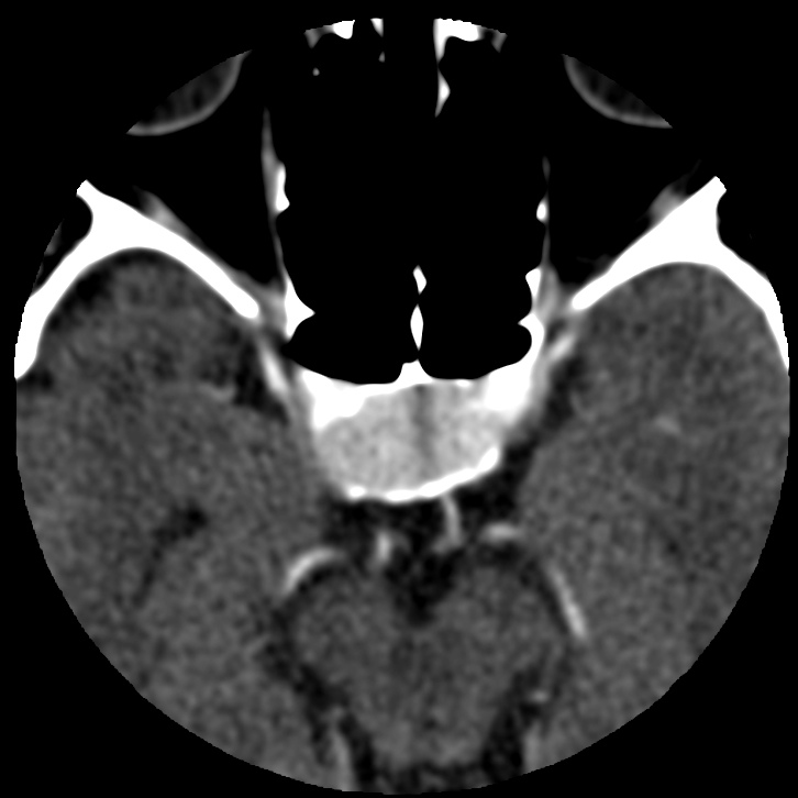 Pituitary Macroadenoma | Image | Radiopaedia.org