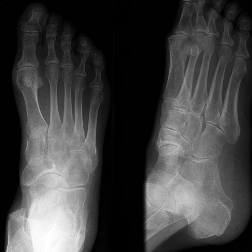 Xray Of Foot Stress Fracture