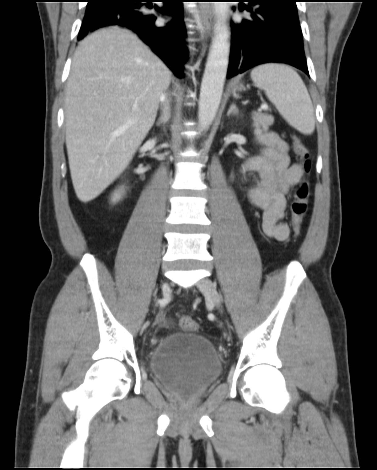 Vasitis | Image | Radiopaedia.org