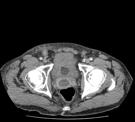 Vasitis and seminal vesicle abscess | Radiology Case | Radiopaedia.org