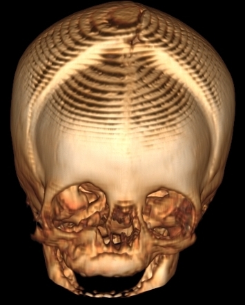 Brachycephaly (bi-coronal and bi-lambdoid synostosis) | Radiology Case ...