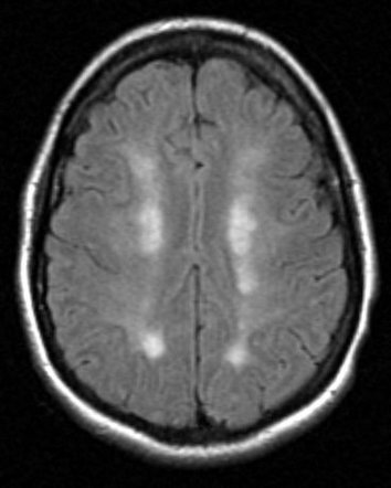 Watershed cerebral infarction | Radiology Reference Article ...