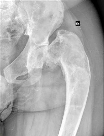 Shepherd crook deformity | Radiology Reference Article | Radiopaedia.org