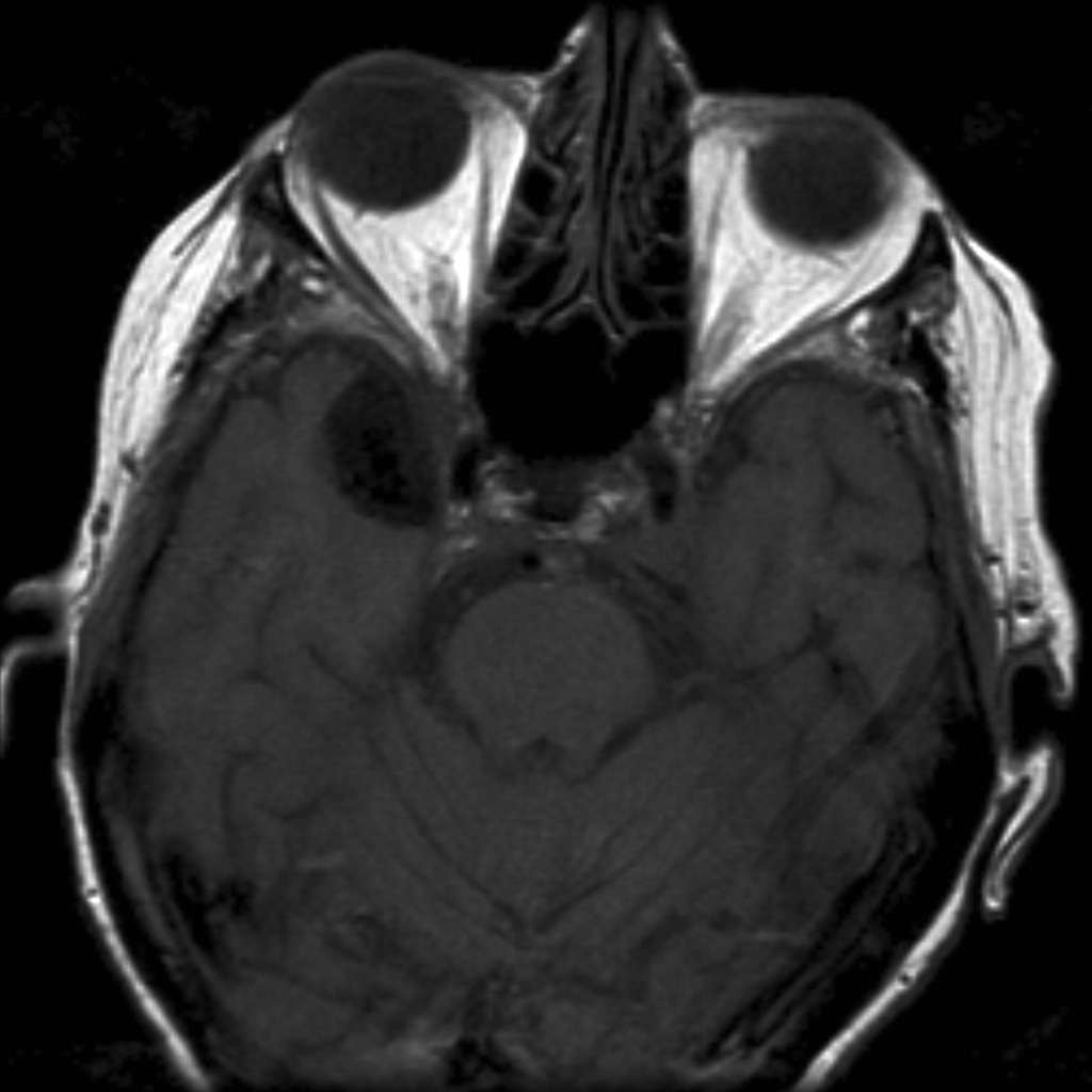 Meningioma - burnt-out | Image | Radiopaedia.org