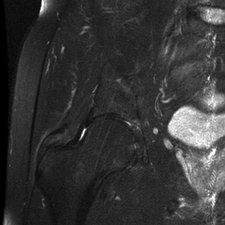 Gluteus medius tear | Image | Radiopaedia.org