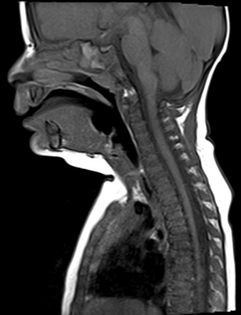 Ectopic Thymus 