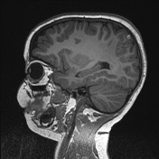 cortical vein thrombosis