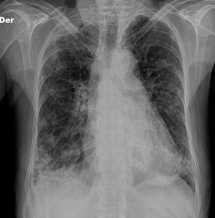 fibrosis pulmonary cause unknown apical pleural thickening ray radiopaedia chest frontal version