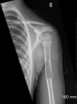 Fallen fragment sign of unicameral bone cyst | Radiology Case ...