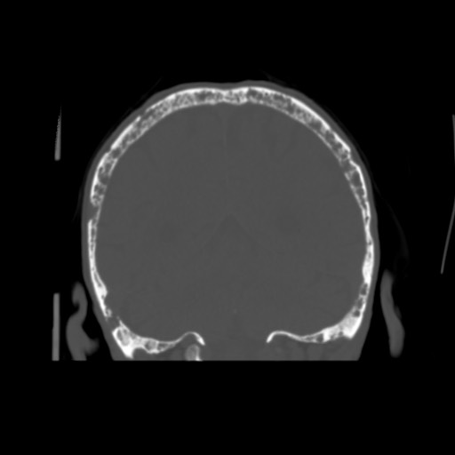 Multiple Myeloma Image Radiopaedia Org