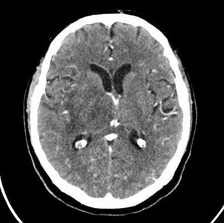 Cerebritis | Radiology Reference Article | Radiopaedia.org