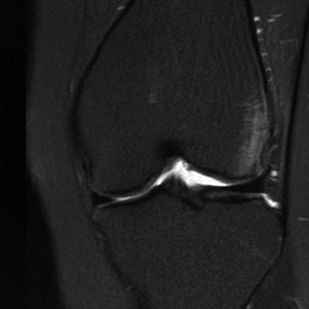 Lateral patellar dislocation | Image | Radiopaedia.org