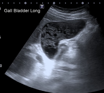 Gallbladder sludge | Radiology Case | Radiopaedia.org